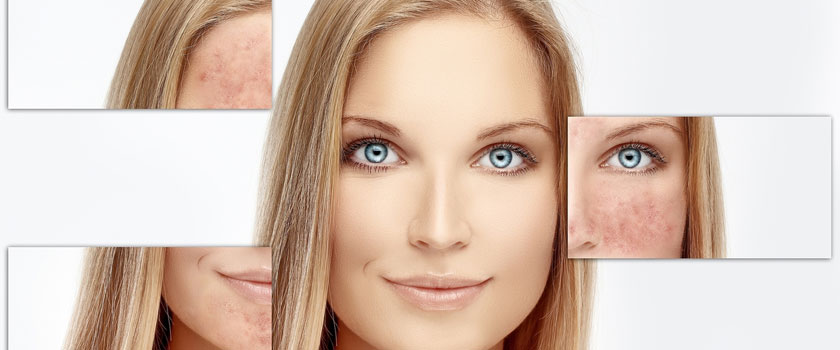رفع قرمزی صورت با استفاده از مواد طبیعی و آرایش