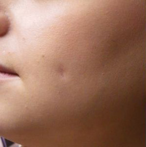 عوامل ایجاد لکه های پوستی ناشی از زخم