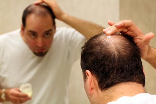 ریزش مو ژنتیکی است به ویژه در سنین بالا و ارتباط نزدیکی با استرس دارد