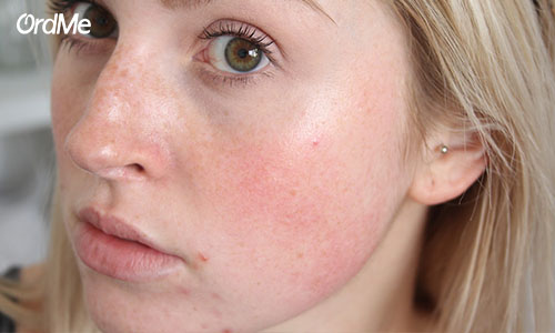 عوارض جانبی درمان های طبیعی برای لکه های تیره روی پوست