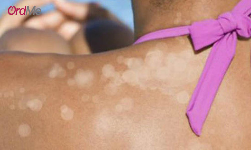 بهترین روش برای از بین بردن انواع لک پوستی ناشی از نور خورشید