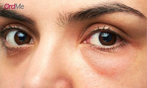 عوامل مؤثر در ایجاد پف زیر چشم