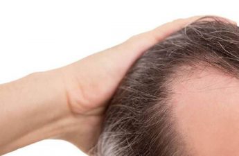 بررسی مراحل ۷گانه الگوی ریزش موی آقایان و راه های درمان آن