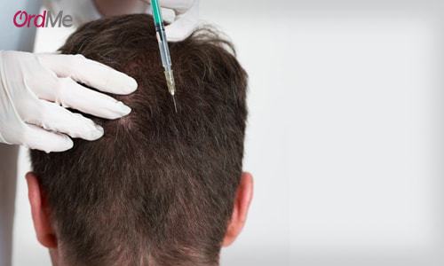 روش های درمان ریزش موی آقایان