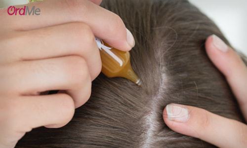 استفاده از ماینوکسیدیل برای جلوگیری از ریزش مو