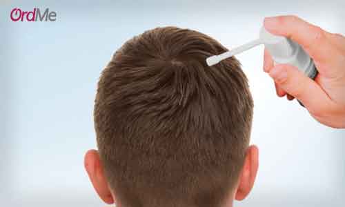 ماینوکسیدیل یکی از عوامل مؤثر در درمان ریزش مو