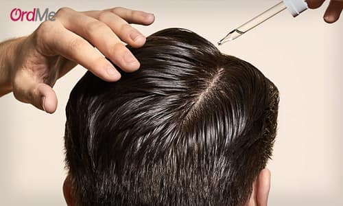 درمان کم پشت شدن مو با ماینوکسیدیل
