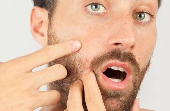 چند روش ساده و کاربردی برای درمان جوش صورت با سیر