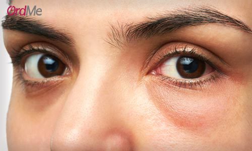 علت پف زیر چشم و مراقبت از پوست پس از زایمان