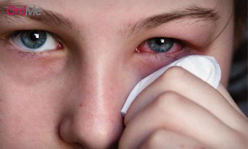 قرمزی و عفونت چشم یکی از عوارض استفاده از کرم پودر