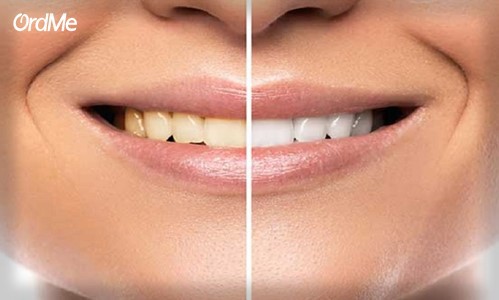 خراب شدن دندان‌ها از اثرات عصبانیت بر زیبایی