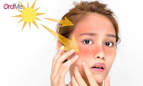 خواص روغن اسطوخودوس برای درمان آفتاب سوختگی