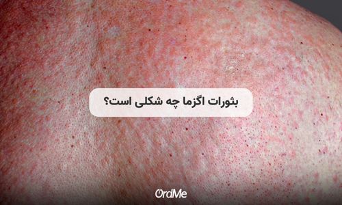 بثورات اگزما چه شکلی است